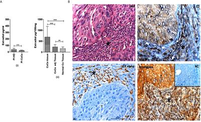 The Immune Microenvironment in Human Papilloma Virus-Induced Cervical Lesions—Evidence for Estrogen as an Immunomodulator